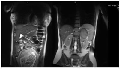 Cushing’s syndrome during pregnancy - two case reports